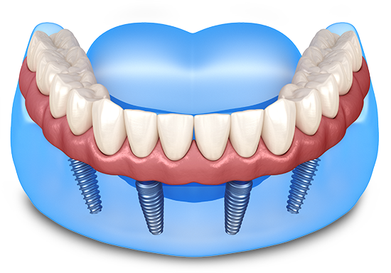 full arch implants graphic