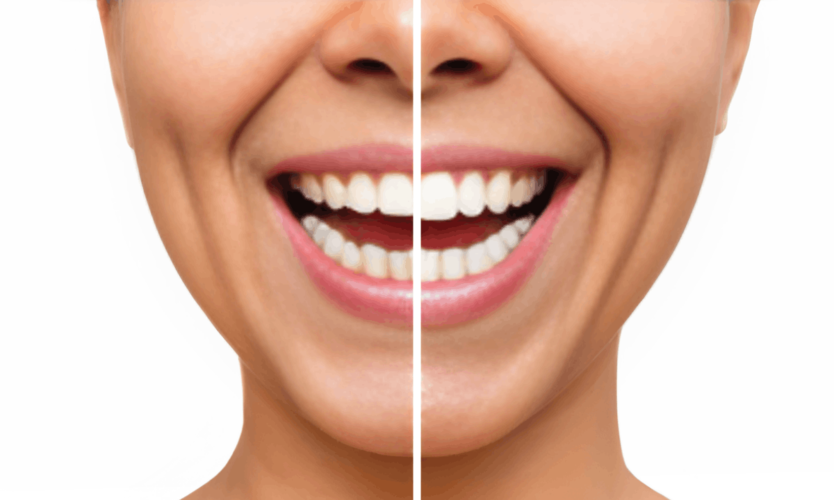 can-you-remove-veneers-here-s-what-your-dentist-wants-you-to-know-first